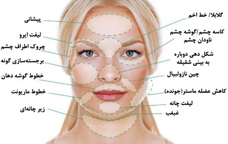 عوارض لیفت با نخ چیست؟ عوارض لیفت با نخ چیست؟
