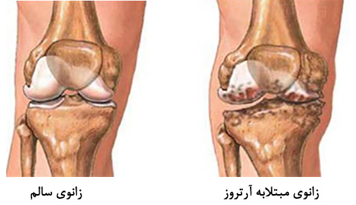 آرتروز ژنتیکی است؟ آرتروز ژنتیکی است؟
