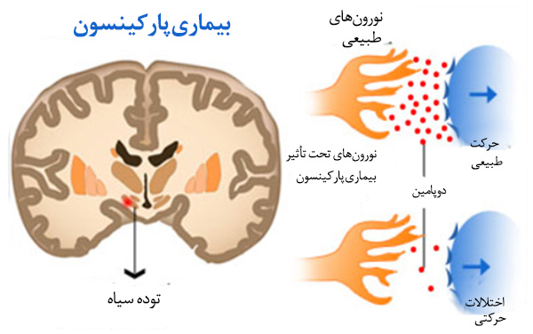 رابطه مصرف قهوه و تشدید علائم پارکینسون رابطه مصرف قهوه و تشدید علائم پارکینسون