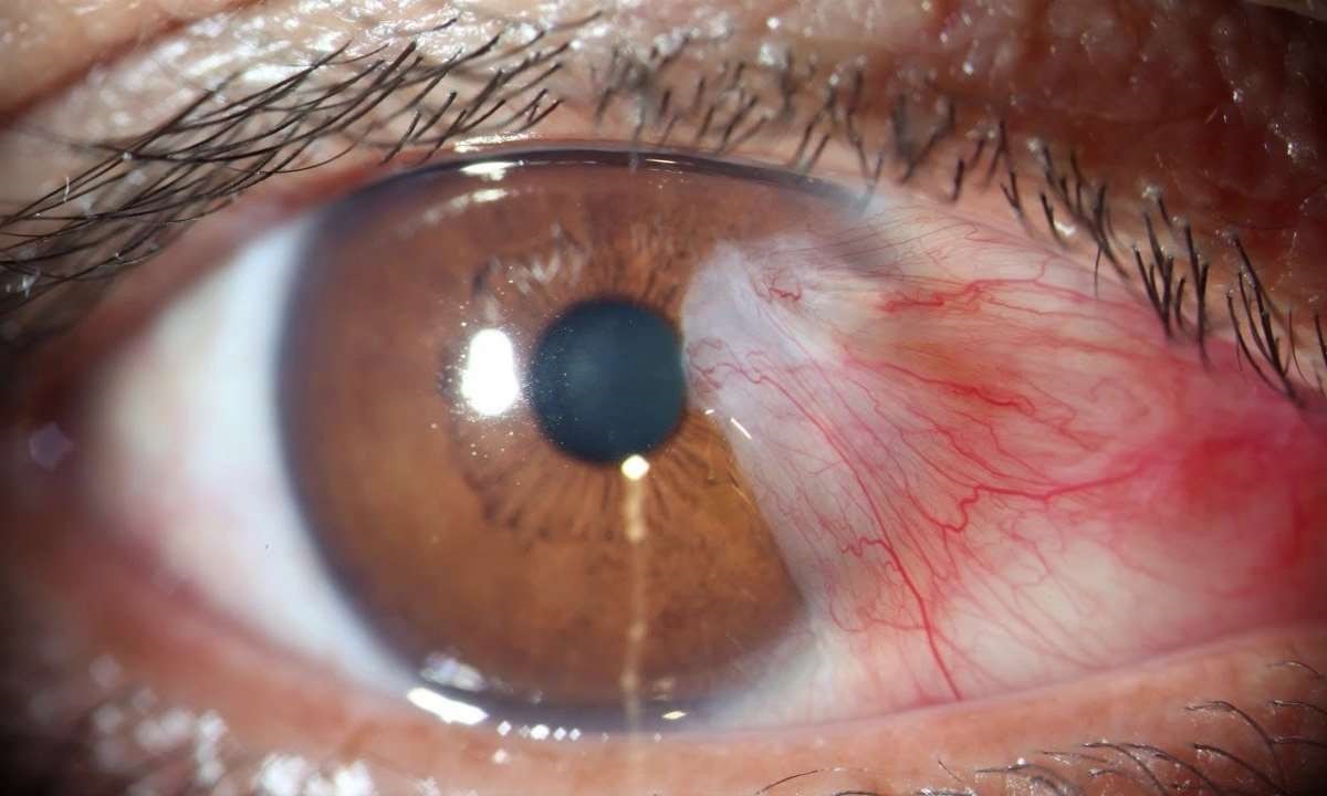 ناخنک چیست و چرا بوجود می آید؟ ناخنک چیست و چرا بوجود می آید؟