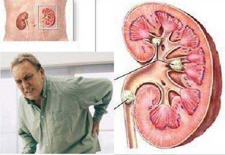 بهترین روش برای دفع سریع سنگ کلیه بهترین روش برای دفع سریع سنگ کلیه