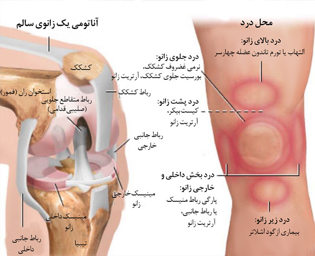 زانو درد را با این ۲ خوراکی ریشه کن کنید!