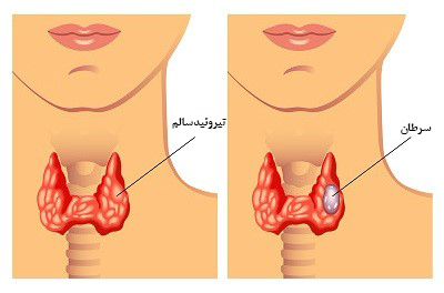 عادت هایی که تیروئید را از کار میندازد عادت هایی که تیروئید را از کار میندازد