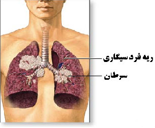 خطر ابتلا به بیماری ریوی این افراد را تهدید می کند خطر ابتلا به بیماری ریوی این افراد را تهدید می کند