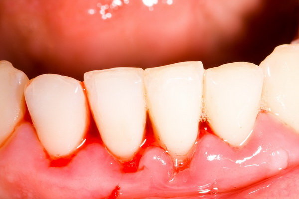 چگونه از بیماری لثه جلوگیری کنیم؟ چگونه از بیماری لثه جلوگیری کنیم؟