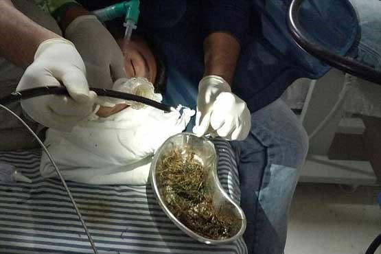 توده یک کیلویی چوب و پلاستیک درشکم یک نوجوان! +عکس توده یک کیلویی چوب و پلاستیک درشکم یک نوجوان! +عکس