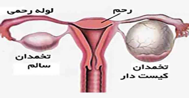 این گیاهان کیست تخمدان را ضربه فنی می کند این گیاهان کیست تخمدان را ضربه فنی می کند