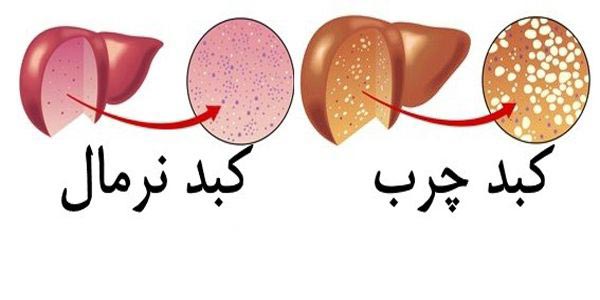 مبتلایان به کبد چرب چه خوراکی‌هایی مصرف کنند؟