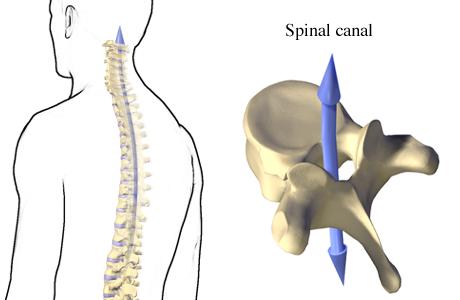 علت تنگی کانال نخاع چیست؟ علت تنگی کانال نخاع چیست؟