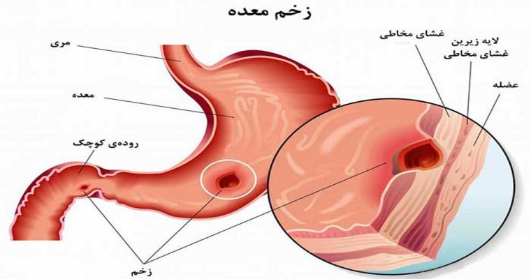 گروه های خونی O در معرض زخم معده!