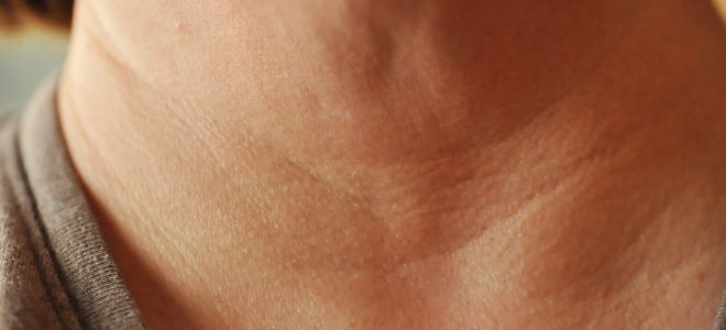 چرا پوست گردن سیاه می شود؟ چرا پوست گردن سیاه می شود؟