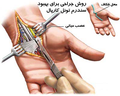 سندرم تونل کارپ چیست؟ + راه درمان