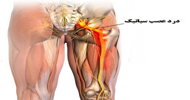 سیاتیک چیست؟ + علائم سیاتیک چیست؟ + علائم