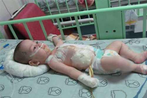 دوقلوهای اصفهانی جدا شدند + تصاویر