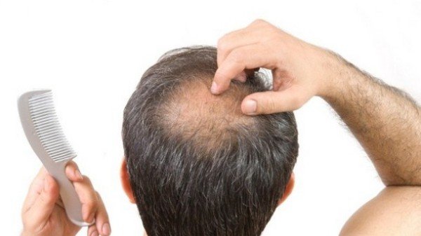 طاسی سکه‌ای و درمان‌های آن