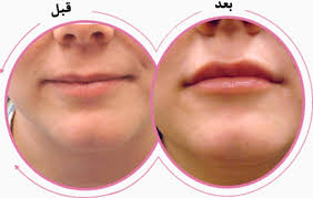 ۸ نکته مهم برای حجیم‌سازی لب/پروتز خوب است؟