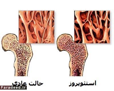 عاقبت عدم مصرف کلسیم چه خواهد بود؟