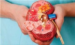 علائم عفونت کلیه‌ها را بشناسید