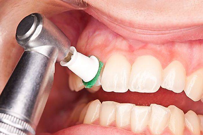 آیا جرم‌گیری دندان کار درستی است؟