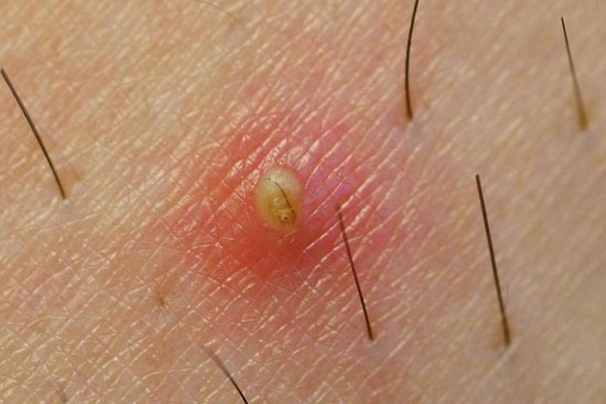 چگونه از شر موهای زیرپوستی خلاص شویم؟ چگونه از شر موهای زیرپوستی خلاص شویم؟