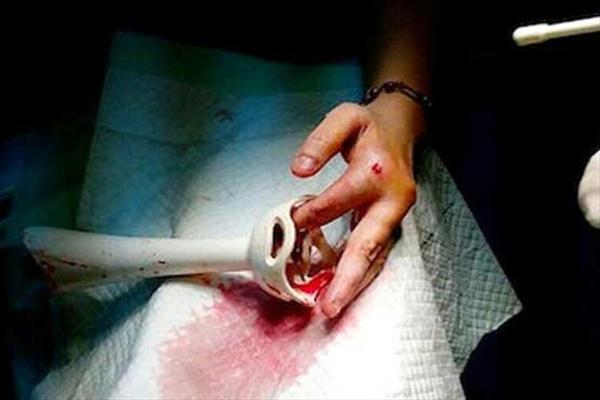 گوشت کوب برقی مار دست زن جوان داد