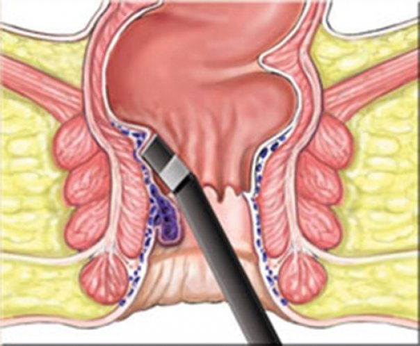 دلایل ابتلا به بواسیر کدامند؟ دلایل ابتلا به بواسیر کدامند؟
