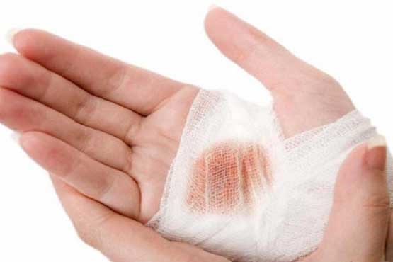 چگونه سوختگی را درمان کنیم؟ + راه های طبیعی