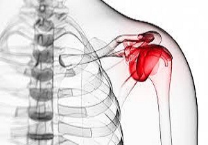 عارضه یخ زدگی شانه چیست؟