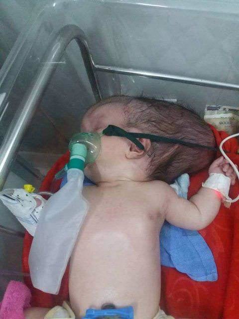 تولد نوزادی با نصف جمجمه در کامبوج +عکس