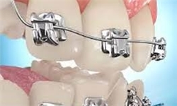عوارض استفاده از لمینیت و کامپوزیت به جای درمان ارتودنسی