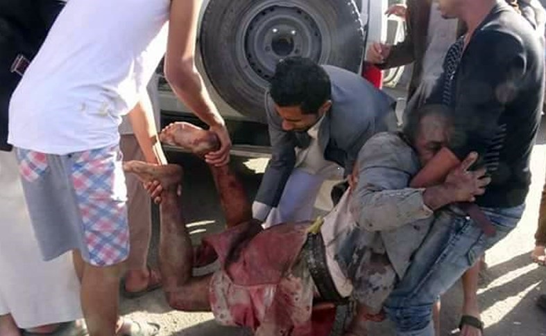 حقوق بشر به سَبک رژیم آمریکا / مشارکت با سعودی‌ها در مثله‌کردن کودکان یمنی و سکوت سازمان ملل!