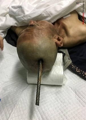 زنده ماندن معجزه آسای یک کارگر ساختمان بعد از بر خورد یک میله ۱۰ فیتی به سر+عکس زنده ماندن معجزه آسای یک کارگر ساختمان بعد از بر خورد یک میله ۱۰ فیتی به سر+عکس