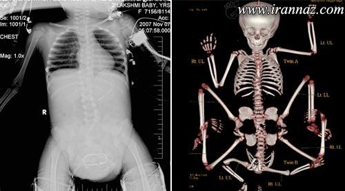 دختری عجیب با 8 دست و پا، 2 معده و 4 کلیه‌