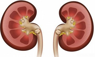 علائم سنگ کلیه چیست؟