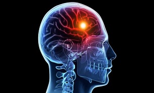در هر پنج دقیقه یک ایرانی سکته مغزی می‌کند