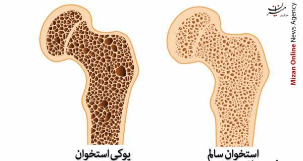 پیشگیری از پوکی استخوان با مصرف کلسیم و ویتامین D