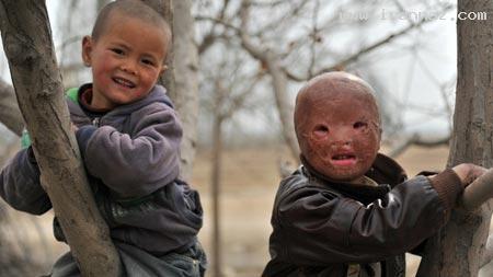 زندگی دردناک کودکی 6 ساله و بدون صورت زندگی دردناک کودکی 6 ساله و بدون صورت