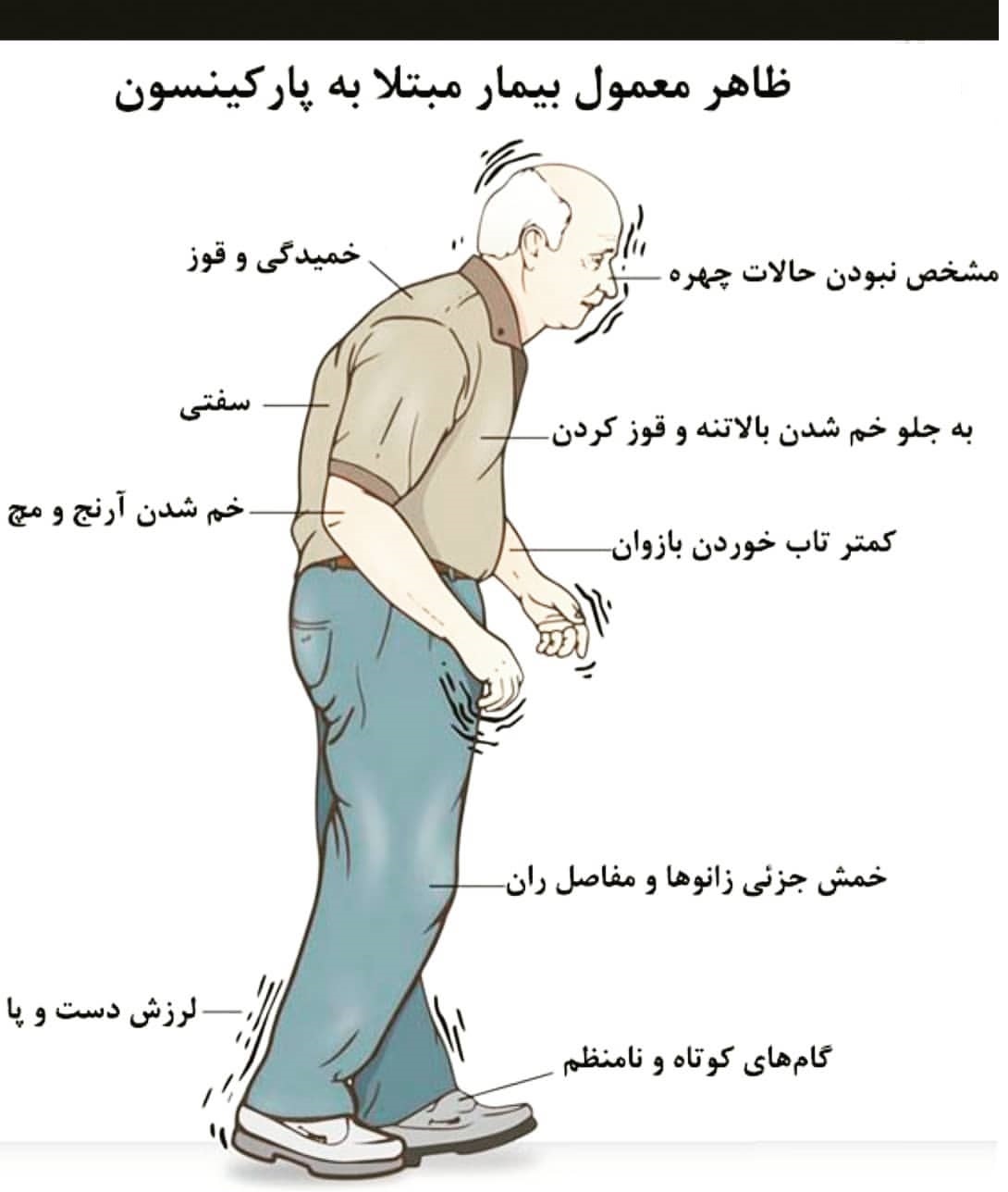 معرفی نشانه های افراد مبتلا به پارکینسون +اینفوگرافی معرفی نشانه های افراد مبتلا به پارکینسون +اینفوگرافی