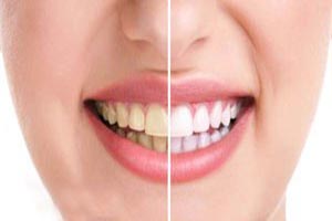 چگونه از زرد شدن دندان ها جلوگیری کنیم؟ چگونه از زرد شدن دندان ها جلوگیری کنیم؟