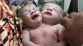تولد نوزاد دو سر در بنگلادش +عکس