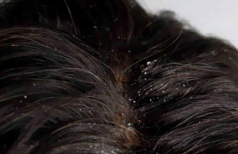 ترفندهای خانگی برای ریشه کن کردن شوره و خارش پوست سر! ترفندهای خانگی برای ریشه کن کردن شوره و خارش پوست سر!
