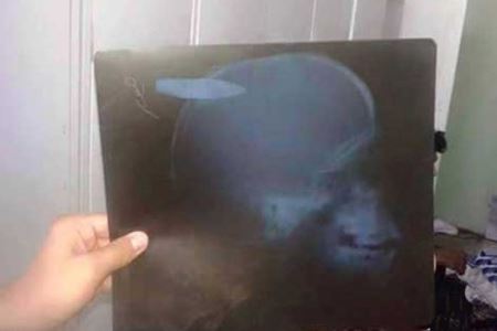 فشنگ عجیب در سر یک پسربچه +عکس فشنگ عجیب در سر یک پسربچه +عکس