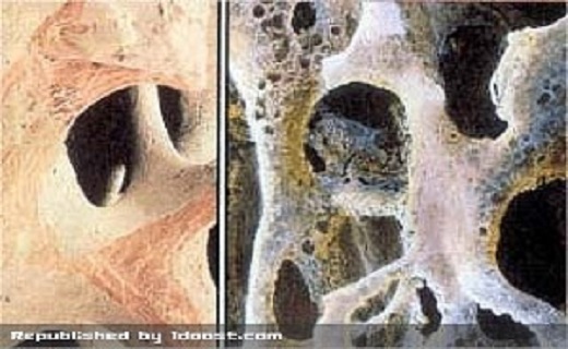 پوکی استخوان در کمین آقایان +