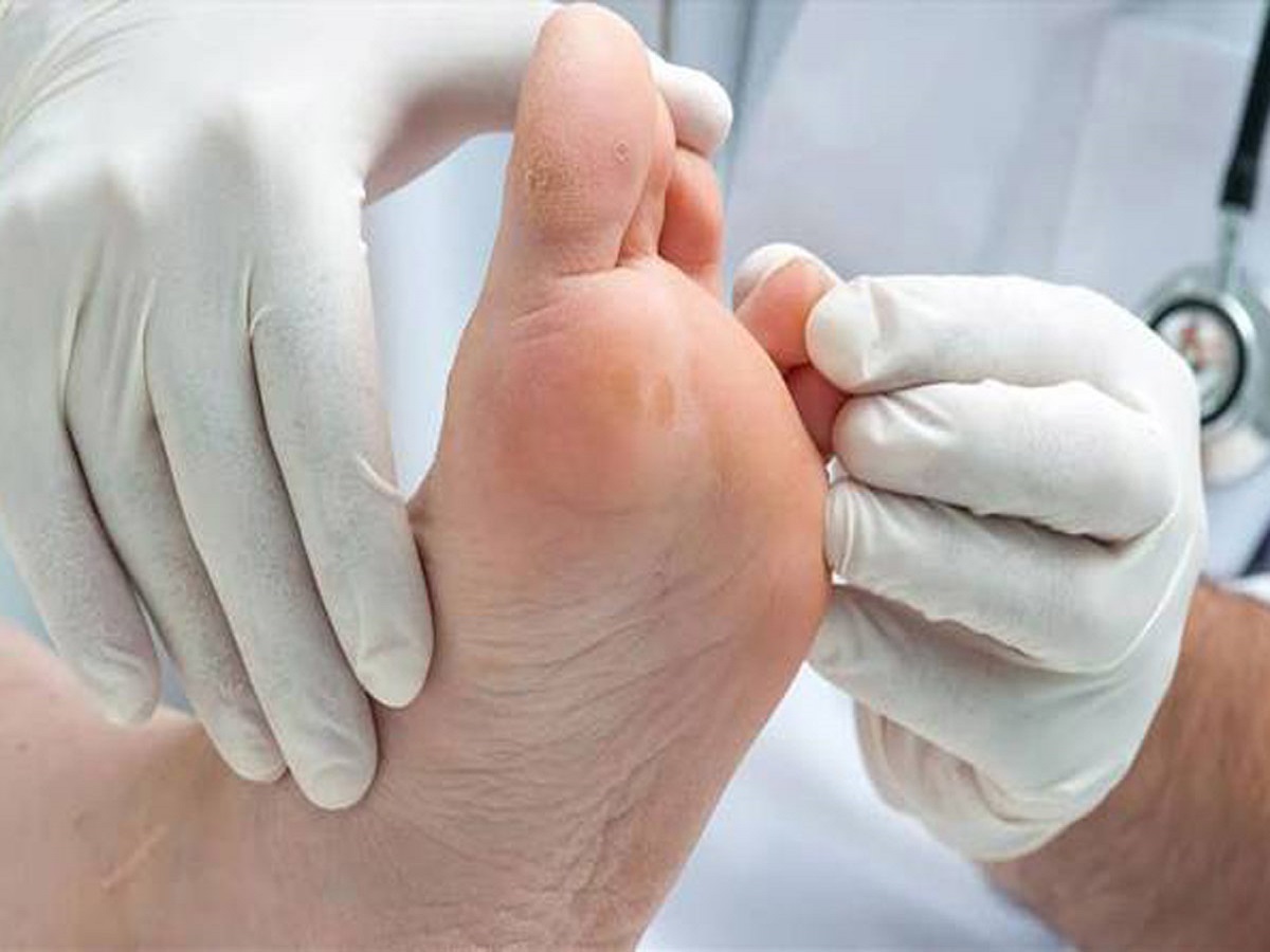 علت بروز زخم پا در افراد دیابتی چیست؟ /قطع پای ۱۵ درصد از دیابتیها علت بروز زخم پا در افراد دیابتی چیست؟ /قطع پای ۱۵ درصد از دیابتیها