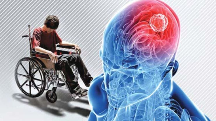 خطر ابتلا به ام‌اس در میان ساکنان شهر‌ها ۳۰ درصد بیشتر است