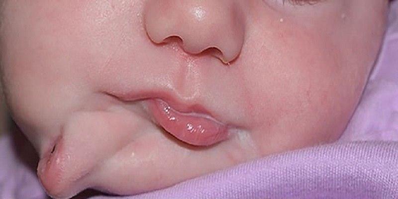 تولد یک نوزاد عجیب با دو دهان مجزا تولد یک نوزاد عجیب با دو دهان مجزا