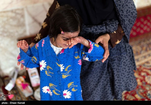 درد و رنج انسان های پروانه ای + تصاویر