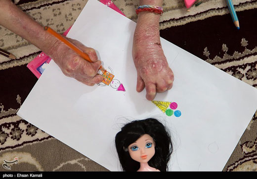 درد و رنج انسان های پروانه ای + تصاویر
