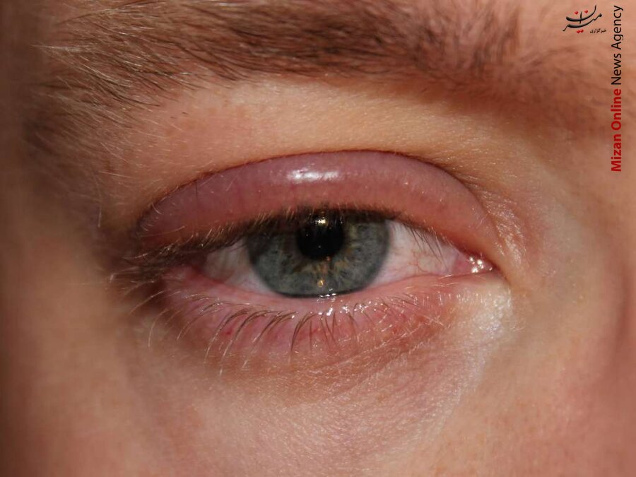 گل مژه چیست و چگونه درمان می شود؟ گل مژه چیست و چگونه درمان می شود؟