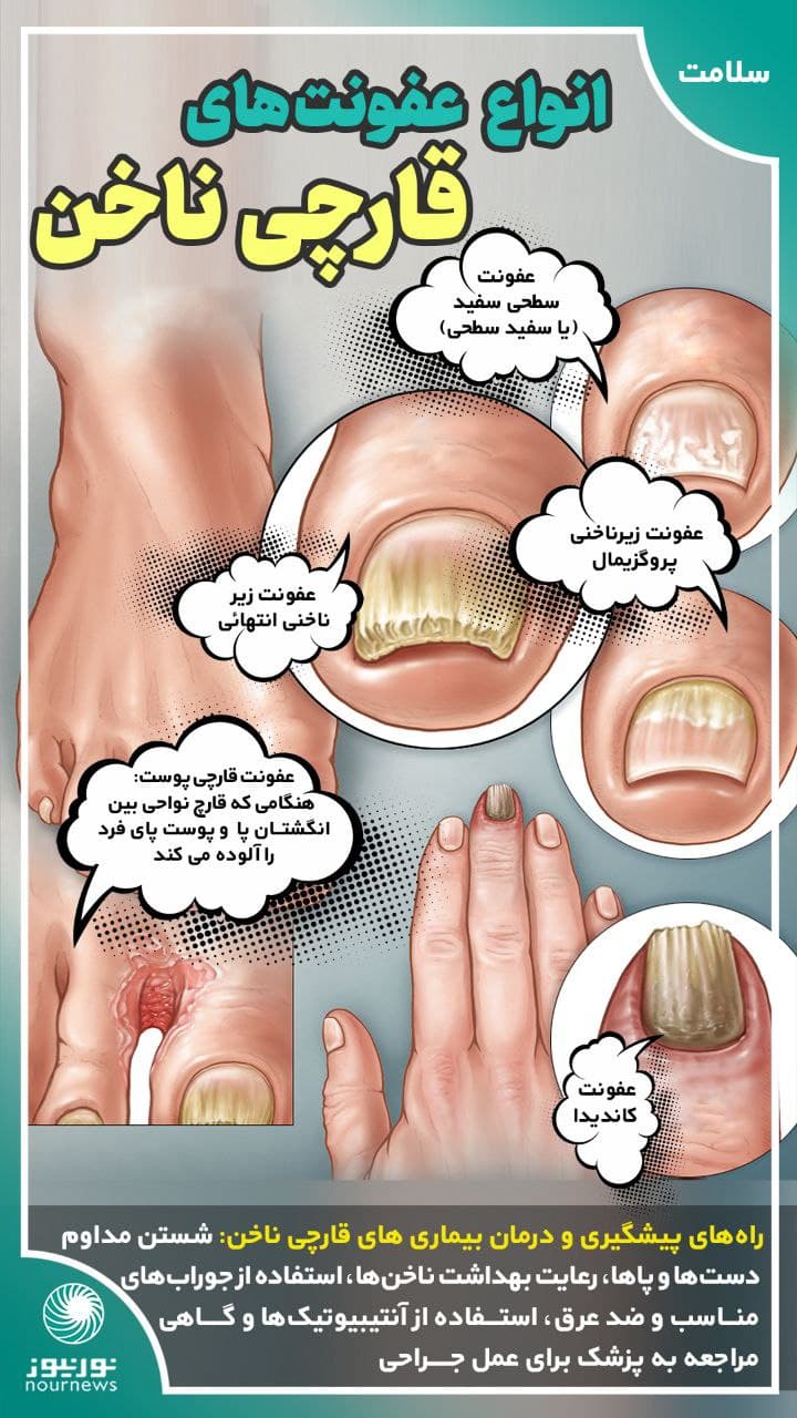 عفونت‌های قارچی ناخن و انواع آن